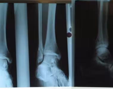 Broken Leg