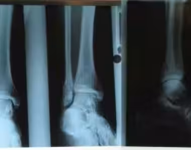 Broken Leg