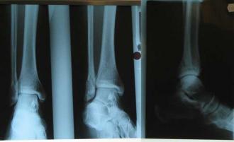 Broken leg X-ray