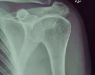 Shoulder surgery