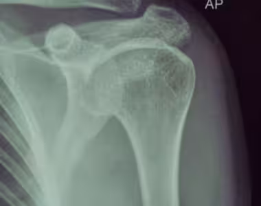 Shoulder surgery