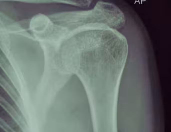 Shoulder surgery