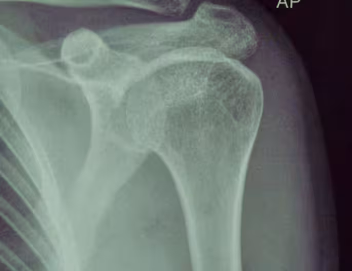 Shoulder surgery