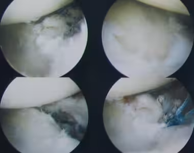 Internal shoulder photos