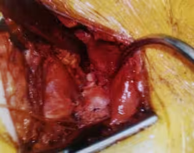 Shoulder innards