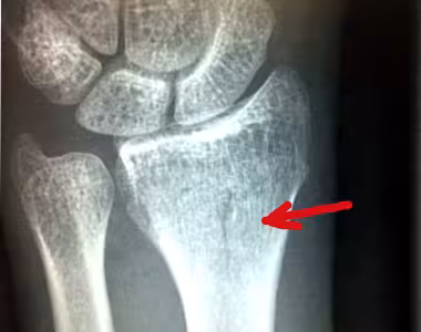 Busted arm