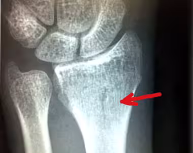 Busted arm